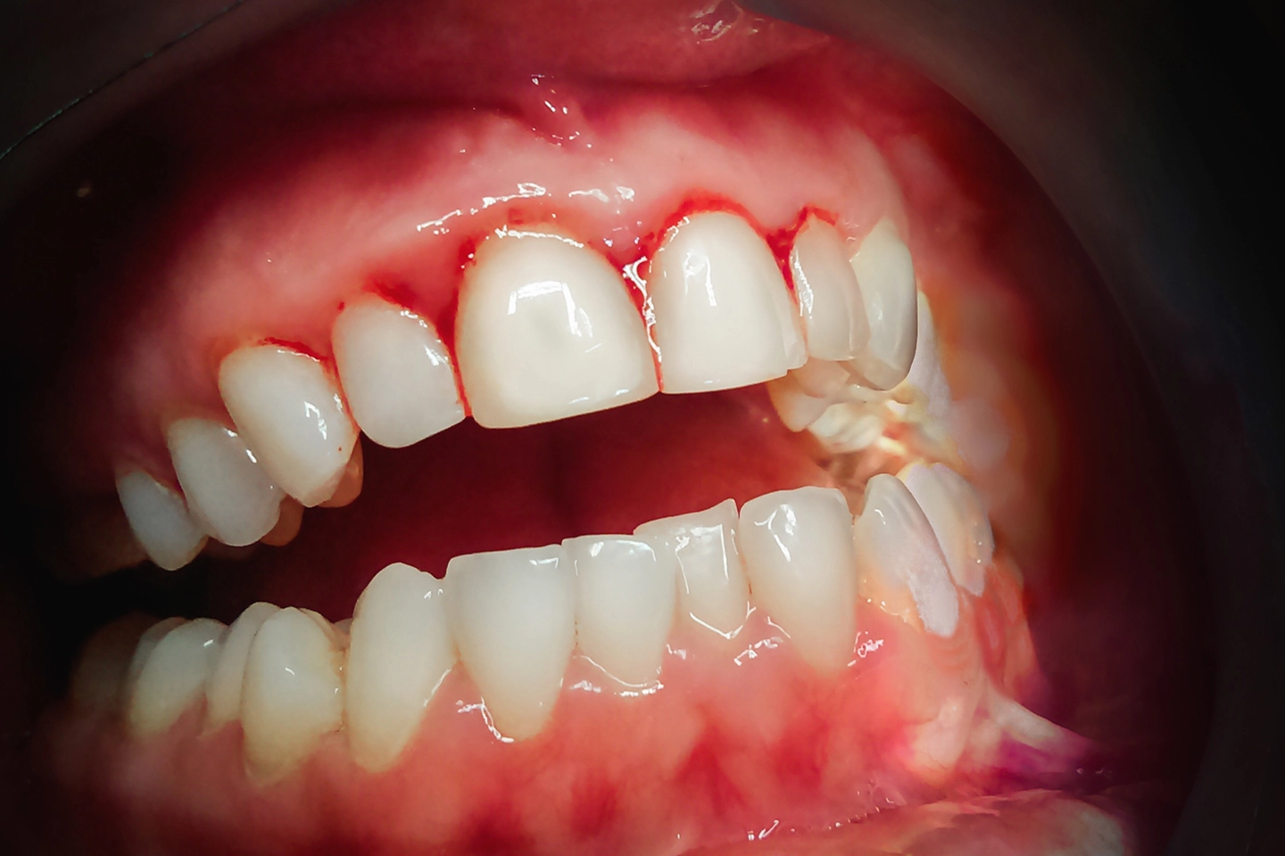 Dental Cleanings