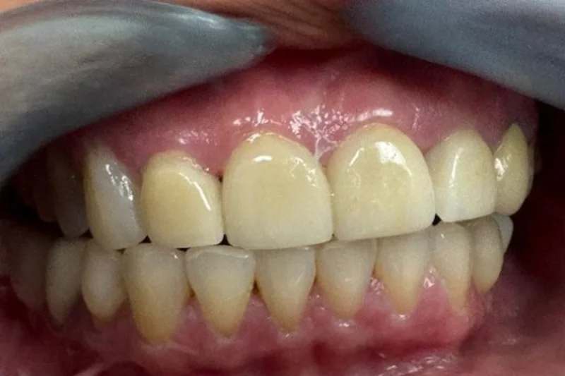 Actual Patient after Veneers
