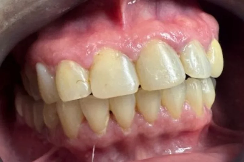 Actual Patient before Veneers