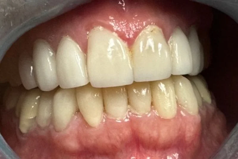Actual Patient after Veneers