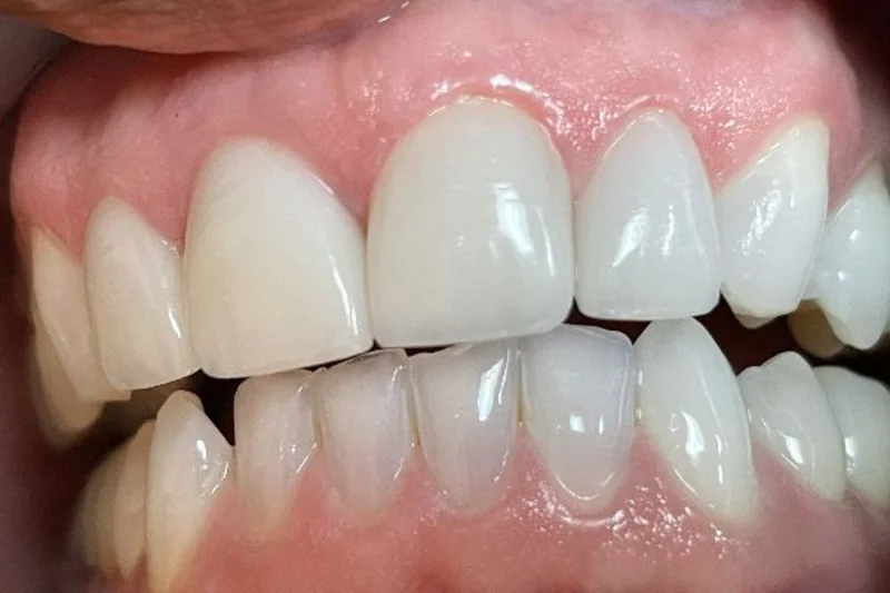 Actual Patient after Veneers