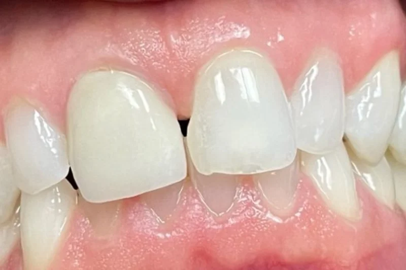 Actual Patient before Veneers