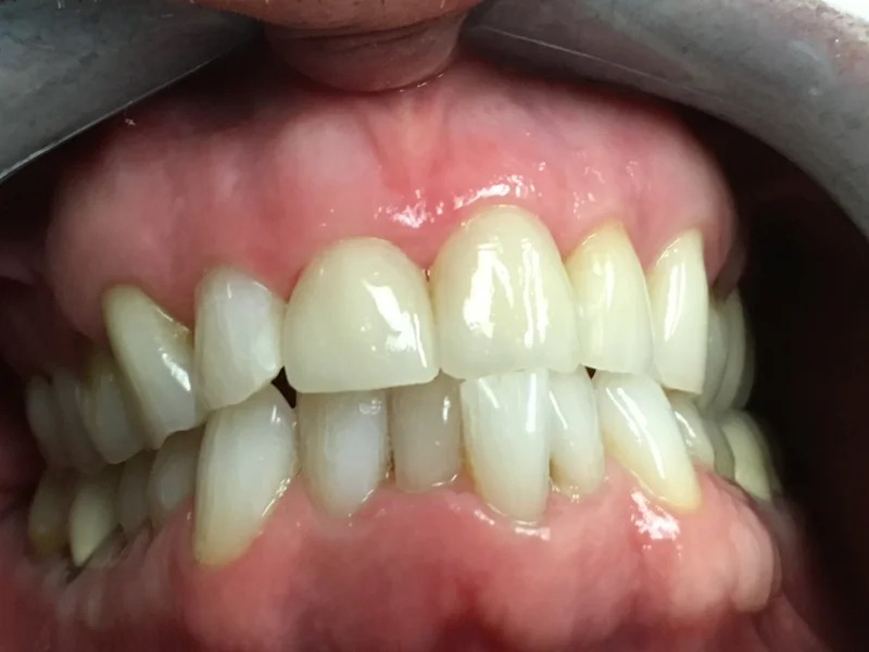 Actual Patient after Bonding