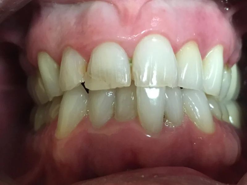 Actual Patient before Bonding
