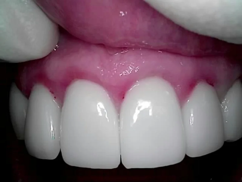Actual Patient after Cosmetic Dentistry