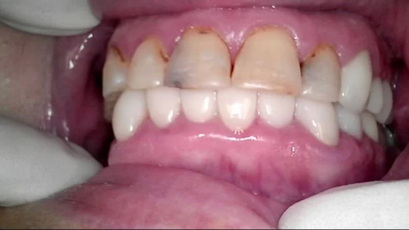 Actual Patient before Cosmetic Dentistry