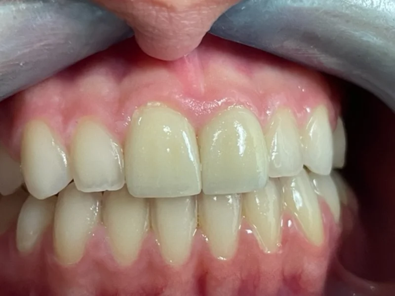 Actual Patient after Cosmetic Dentistry