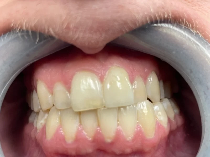Actual Patient after Cosmetic Dentistry