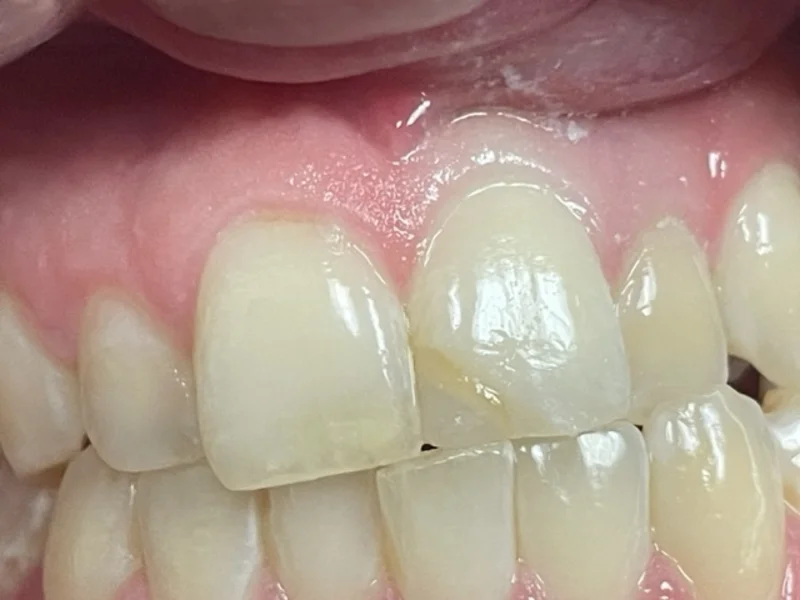 Actual Patient before Cosmetic Dentistry