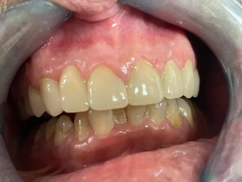 Actual Patient after Cosmetic Dentistry