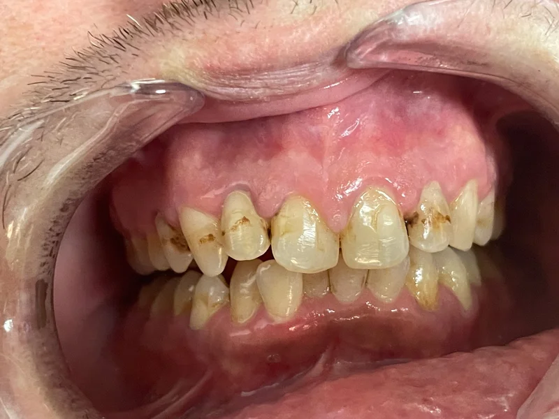 Actual Patient before Cosmetic Dentistry