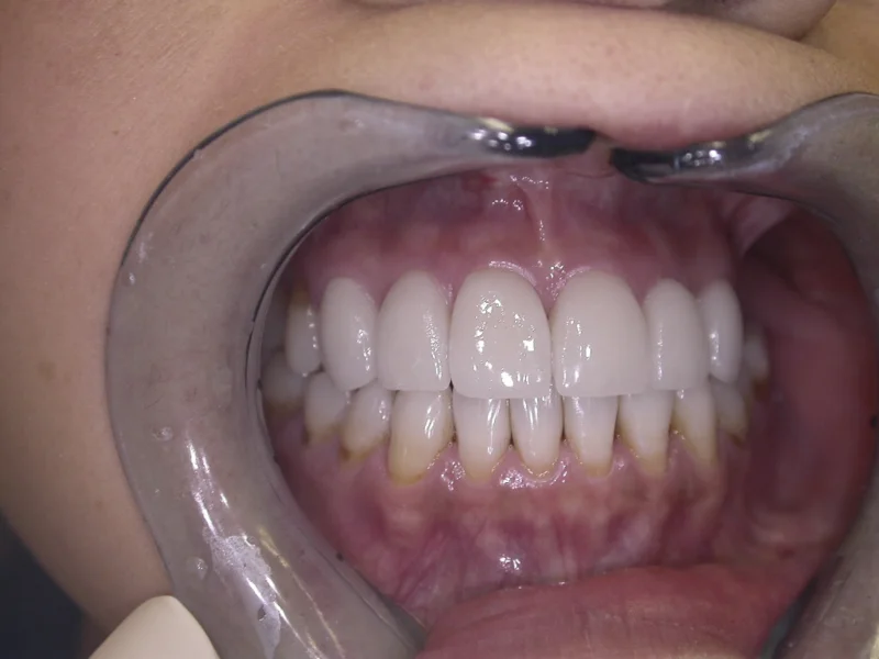 Actual Patient after Veneers
