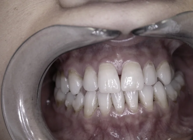 Actual Patient before Veneers