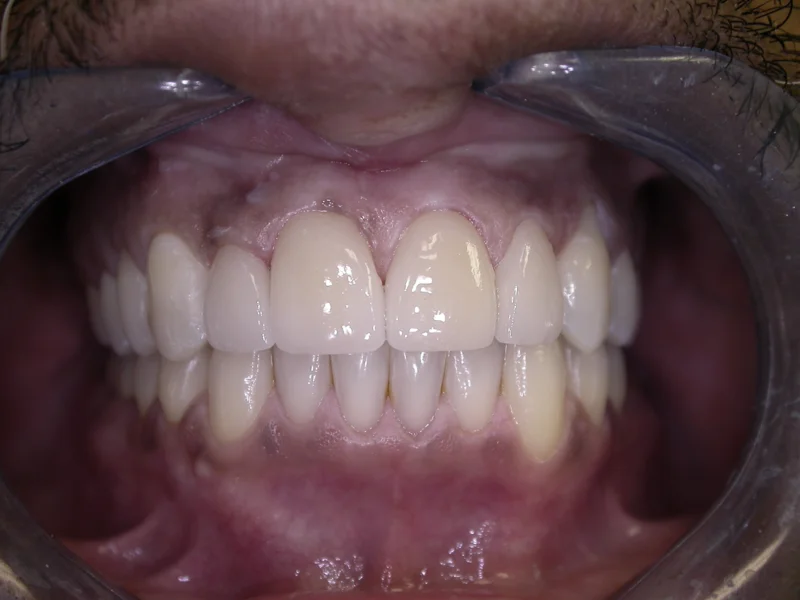 Actual Patient after Veneers