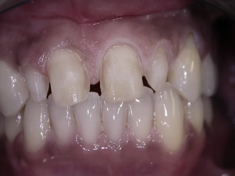 Actual Patient before Veneers