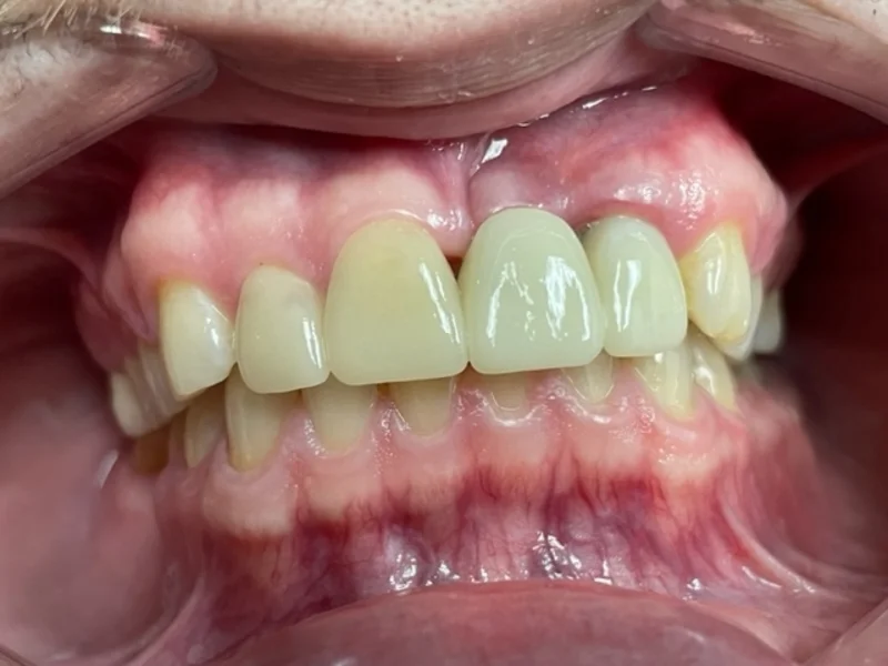 Actual Patient after Cosmetic Dentistry