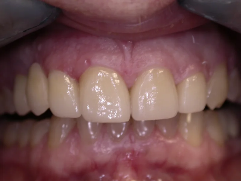 Actual Patient after Veneers