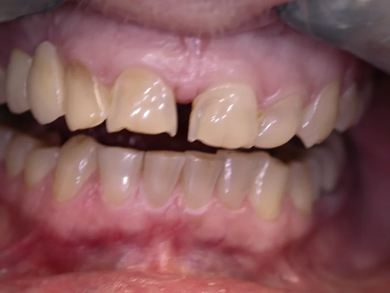 Actual Patient before Veneers