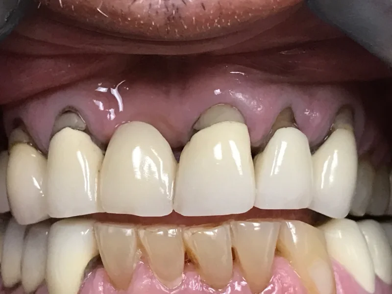 Actual Patient before Veneers
