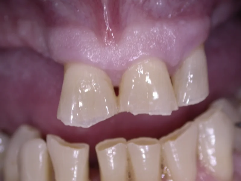 Actual Patient before Crowns