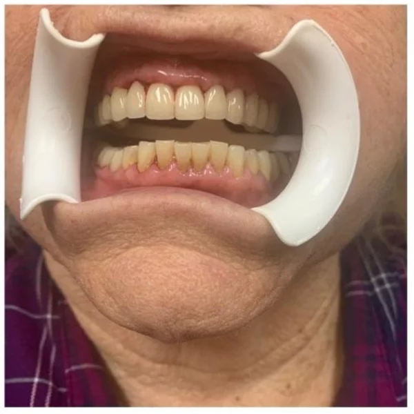 Actual Patient after Veneers