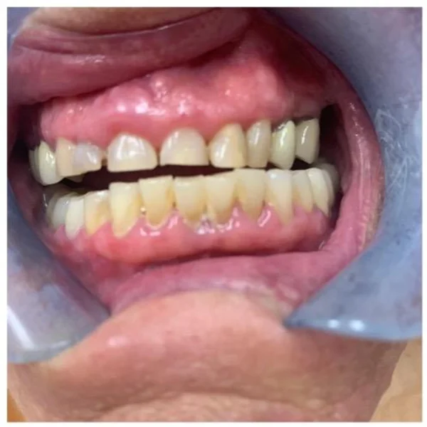 Actual Patient before Veneers