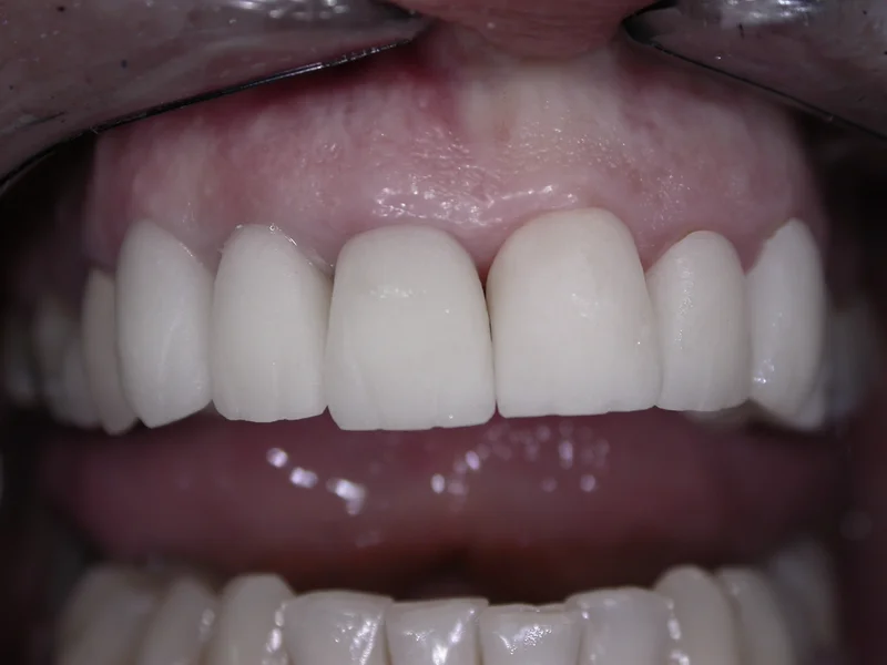 Actual Patient after Crowns