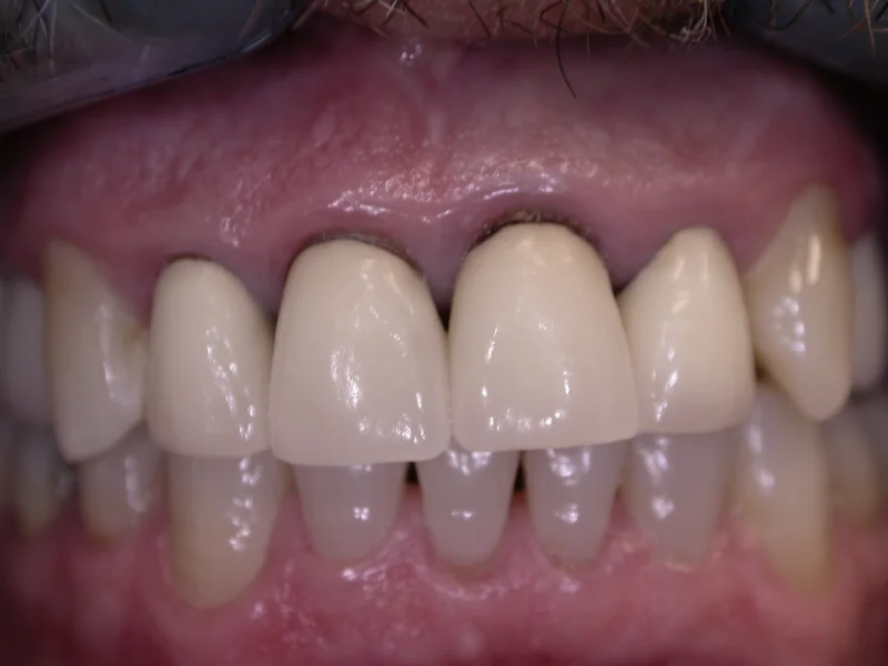 Actual Patient before Crowns